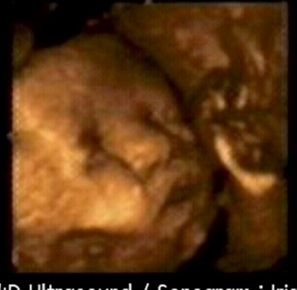 Iris before birth in 4d Ultrasound.